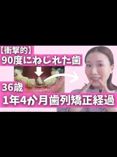 [x]36歳|1年4か月経過報告【歯列矯正経過