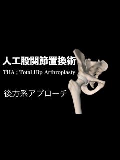[x]人工股関節置換術・後方系アプローチ - YouTube