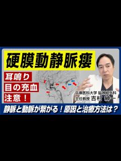 [x]硬膜動静脈瘻とは 脳出血の原因にもなる疾患について脳外科専門医が解説！ - YouTube